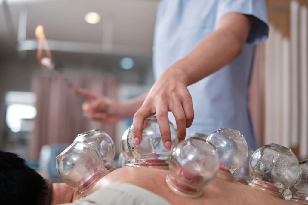 A cupping therapy for pain relief by physical therapist, oriental treatment.